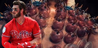 cupping therapy