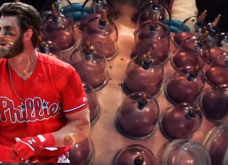 cupping therapy
