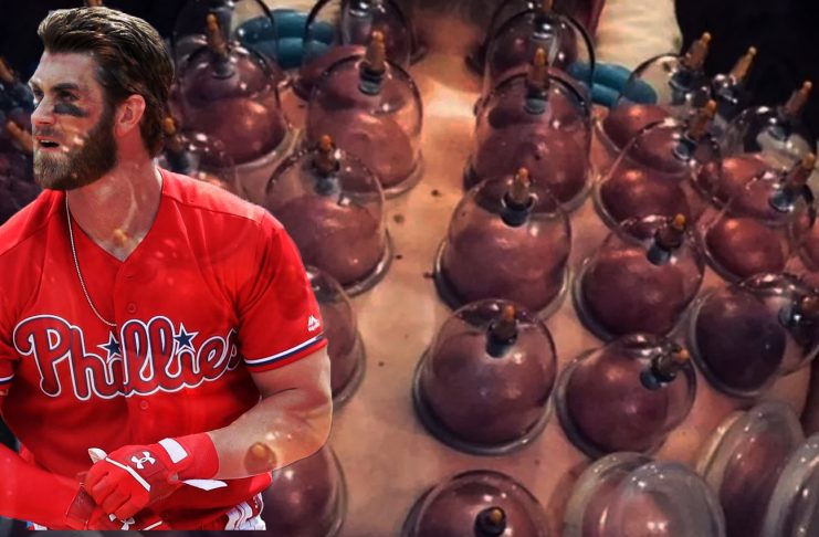 cupping therapy